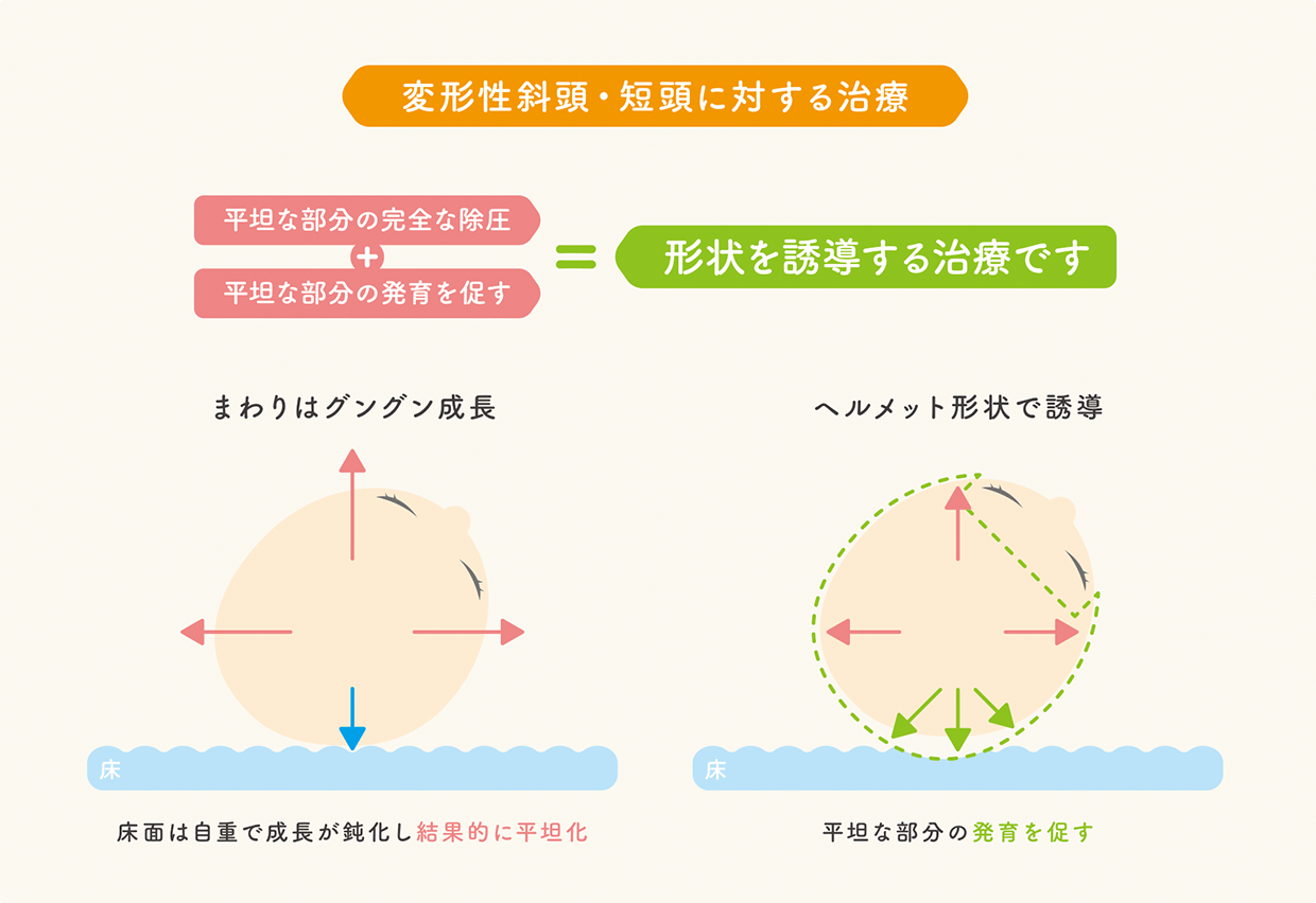 ヘルメット治療イラストイメージ